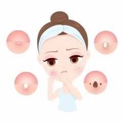 如何祛痘印预防青春痘加重