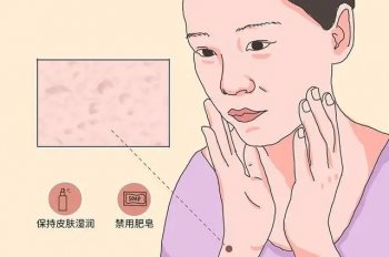 小腿鱼鳞病干痒怎么办？