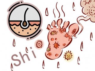 脚癣困扰不用愁，科学防治有妙招